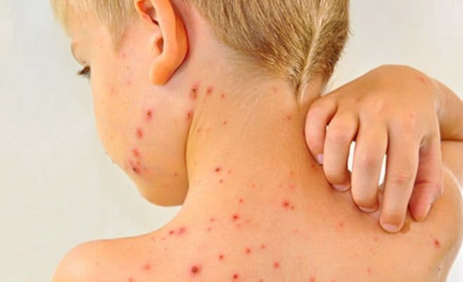 Корь возвращается